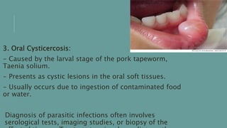 3. Oral Cysticercosis:
- Caused by the larval stage of the pork tapeworm,
Taenia solium.
- Presents as cystic lesions in the oral soft tissues.
- Usually occurs due to ingestion of contaminated food
or water.
Diagnosis of parasitic infections often involves
serological tests, imaging studies, or biopsy of the
 