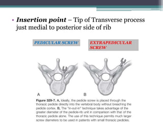Non pedicular fixation techniques for the treatment of spine | PPTX