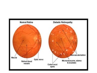 Non proliferative diabetic retinopathy by phaneendra akana | PPTX