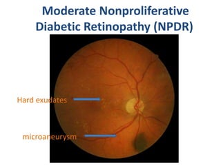 Non proliferative diabetic retinopathy by phaneendra akana | PPTX
