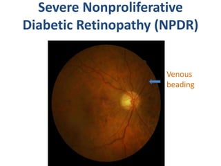 Non proliferative diabetic retinopathy by phaneendra akana | PPTX