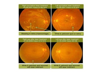 Non proliferative diabetic retinopathy by phaneendra akana | PPTX