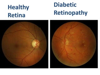 Non proliferative diabetic retinopathy by phaneendra akana | PPTX