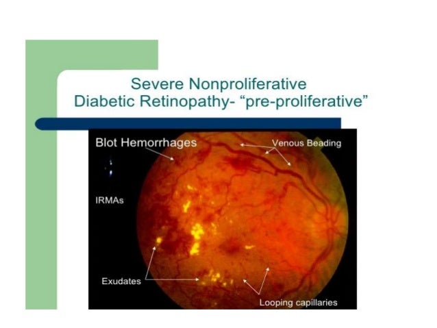 non proliferative diabetic retinopathy by phaneendra akana proliferative diabetic retinopathy