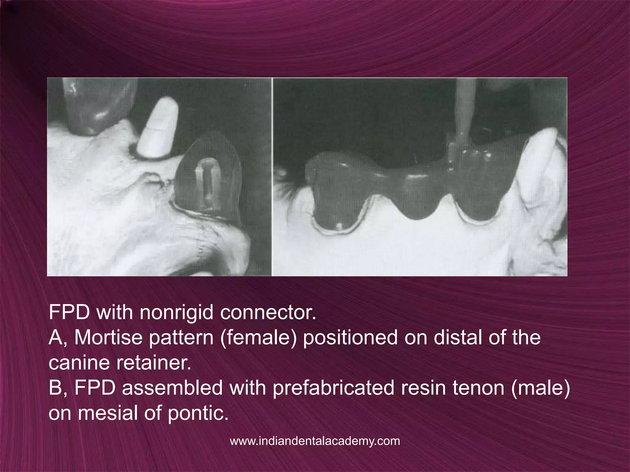 Non rigid connectors in fixed prosthesis / cosmetic dentistry training