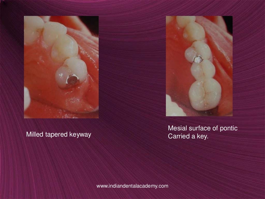 Non rigid connectors in fixed prosthesis / cosmetic dentistry training