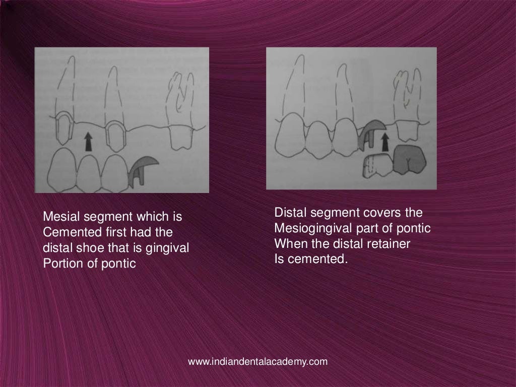 Non rigid connectors in fixed prosthesis / cosmetic dentistry training