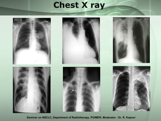 Chest X ray 