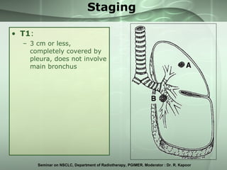 Staging <ul><li>T1 :  </li></ul><ul><ul><li>3 cm or less, completely covered by pleura, does not involve main bronchus </l...