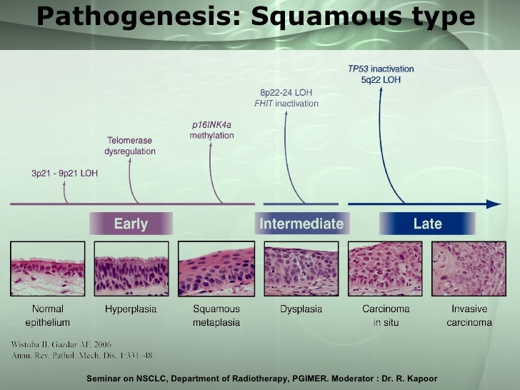 Non Small Cell Lung Cancer