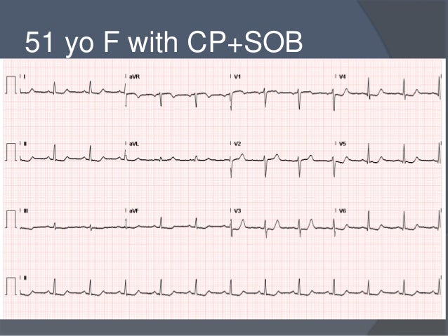 Non st elevation myocardial infarction and unstable angina