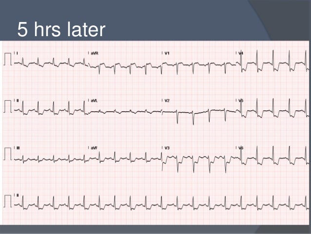 non st elevation myocardial infarction and unstable angina st elevation myocardial infarction