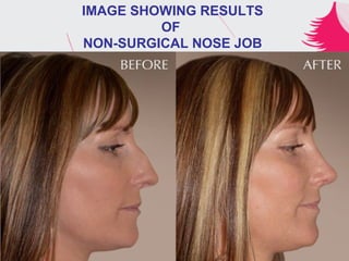 IMAGE SHOWING RESULTS
OF
NON-SURGICAL NOSE JOB
 