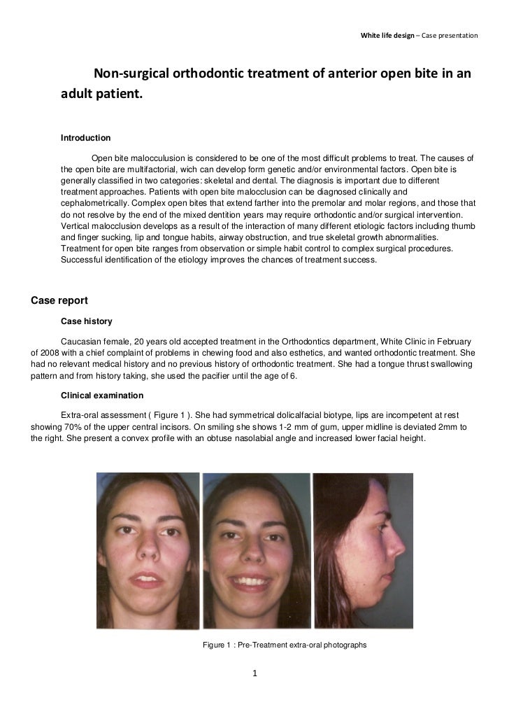 Non surgical orthodontic treatment of anterior open bite in an