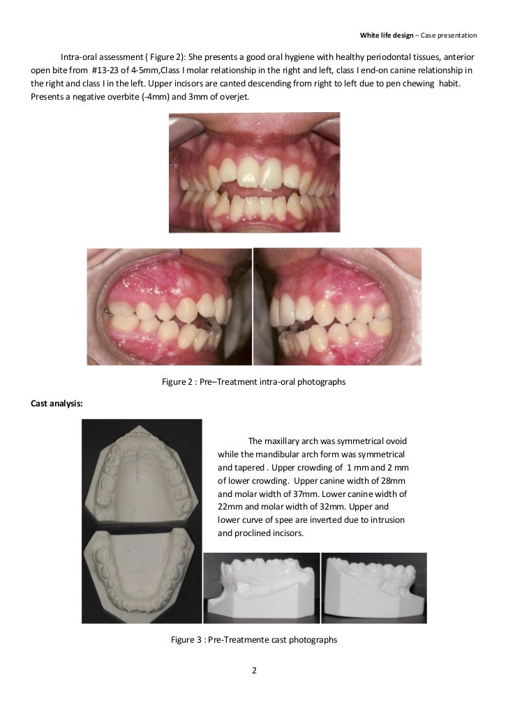 Non surgical orthodontic treatment of anterior open bite in an