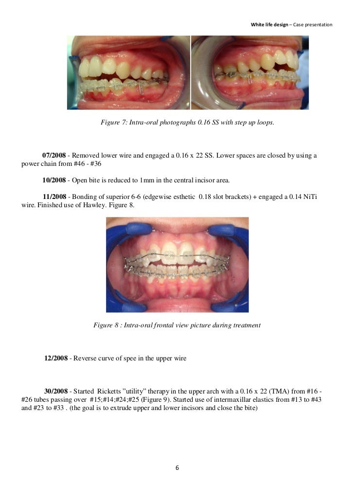 Non surgical orthodontic treatment of anterior open bite in an