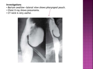 Investigations
• Barium swallow—lateral view shows pharyngeal pouch.
• Chest X-ray shows pneumonia.
• CT neck is very useful.
 