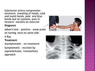 Subclavian artery compression –
excessive sweating of hands, cold
and numb hands, pale and blue
hands due to cyanosis, pain in
forearm worsens on exercise
Diagnosis
Adson’s test – positive – weak pulse
on turning neck on same side
X Ray
Treatment
Asymptomatic – no treatment
Symptomatic – excision by
supraclavicular, transaxillary
approach
 
