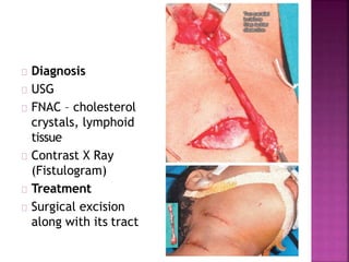 Diagnosis
USG
FNAC – cholesterol
crystals, lymphoid
tissue
Contrast X Ray
(Fistulogram)
Treatment
Surgical excision
along with its tract
 