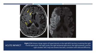 Opercular Acute Infarct Non-traumatic Vasculogenic Lesions of the Brain | PPTX