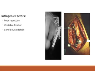 Iatrogenic Factors:
◦Poor reduction
◦Unstable fixation
◦Bone devitalization
 