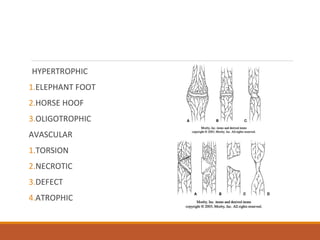 HYPERTROPHIC
1.ELEPHANT FOOT
2.HORSE HOOF
3.OLIGOTROPHIC
AVASCULAR
1.TORSION
2.NECROTIC
3.DEFECT
4.ATROPHIC
 