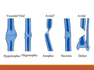 Hypertrophic Atrophic Necrotic DefectOligotrophic
Vascular/Vital Avital? Avital
 