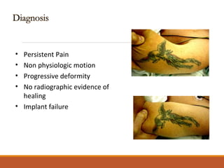 • Persistent Pain
• Non physiologic motion
• Progressive deformity
• No radiographic evidence of
healing
• Implant failure
 