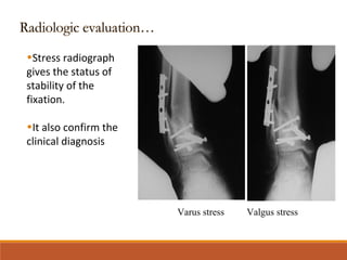 •Stress radiograph
gives the status of
stability of the
fixation.
•It also confirm the
clinical diagnosis
Varus stress Valgus stress
 