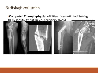 •Computed Tomography: A definitive diagnostic tool having
100% sensitivity but lack of specificity (62%)
 