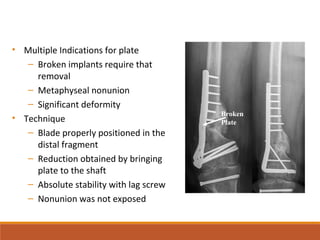 • Multiple Indications for plate
– Broken implants require that
removal
– Metaphyseal nonunion
– Significant deformity
• Technique
– Blade properly positioned in the
distal fragment
– Reduction obtained by bringing
plate to the shaft
– Absolute stability with lag screw
– Nonunion was not exposed
Broken
Plate
 