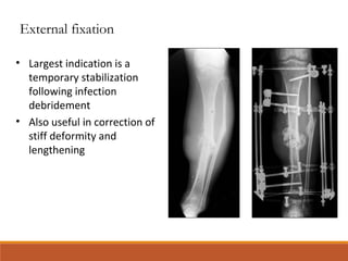 • Largest indication is a
temporary stabilization
following infection
debridement
• Also useful in correction of
stiff deformity and
lengthening
External fixation
 