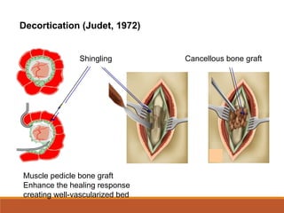 Decortication (Judet, 1972)
Shingling Cancellous bone graft
Muscle pedicle bone graft
Enhance the healing response
creating well-vascularized bed
 