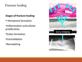 bony bridging
Stages of fracture healing
• Hematoma formation
•Inflammation and cellular
proliferation
•Callus formation
•Consolidation
•Remodeling
Fracture healingFracture healing
 