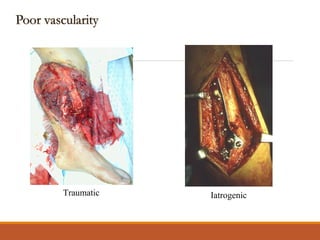 Traumatic Iatrogenic
 