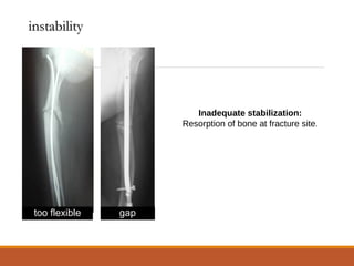 too flexible gap
Inadequate stabilization:
Resorption of bone at fracture site.
instabilityinstability
 