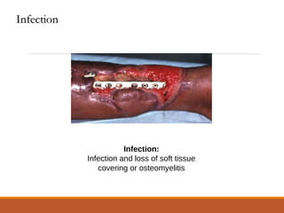 Infection:
Infection and loss of soft tissue
covering or osteomyelitis
InfectionInfection
 