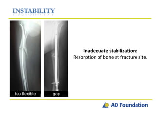 Inadequate stabilization: Resorption of bone at fracture site. too flexible gap 
