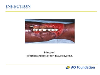 Infection: Infection and loss of soft tissue covering. 