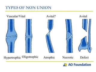 Hypertrophic Atrophic Necrotic Defect Oligotrophic Vascular/Vital Avital? Avital 