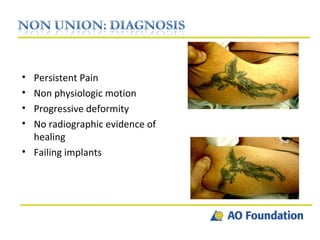Persistent Pain Non physiologic motion Progressive deformity No radiographic evidence of healing Failing implants 