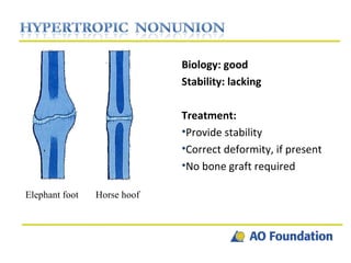 Biology: good  Stability: lacking  Treatment: Provide stability Correct deformity, if present  No bone graft required  Elephant foot  Horse hoof 