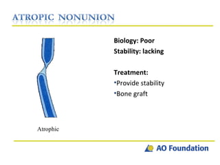Biology: Poor Stability: lacking  Treatment: Provide stability Bone graft Atrophic 
