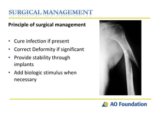 Principle of surgical management Cure infection if present Correct Deformity if significant Provide stability through implants Add biologic stimulus when necessary 