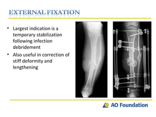 Largest indication is a temporary stabilization following infection debridement Also useful in correction of stiff deformity and lengthening  