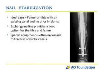 Broken Plate Ideal case – Femur or tibia with an existing canal and no prior implants Exchange nailing provides a good option for the tibia and femur Special equipment is often necessary to traverse sclerotic canals 