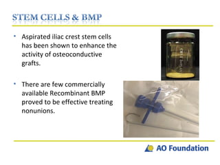 Aspirated iliac crest stem cells has been shown to enhance the activity of osteoconductive grafts. There are few commercially available Recombinant BMP proved to be effective treating nonunions. 