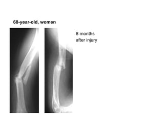 8 months after injury   68-year-old, women 