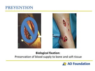 Biological fixation:  Preservation of blood supply to bone and soft tissue 