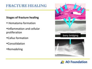 Stages of fracture healing Hematoma formation Inflammation and cellular proliferation Callus formation Consolidation Remodeling bony bridging 